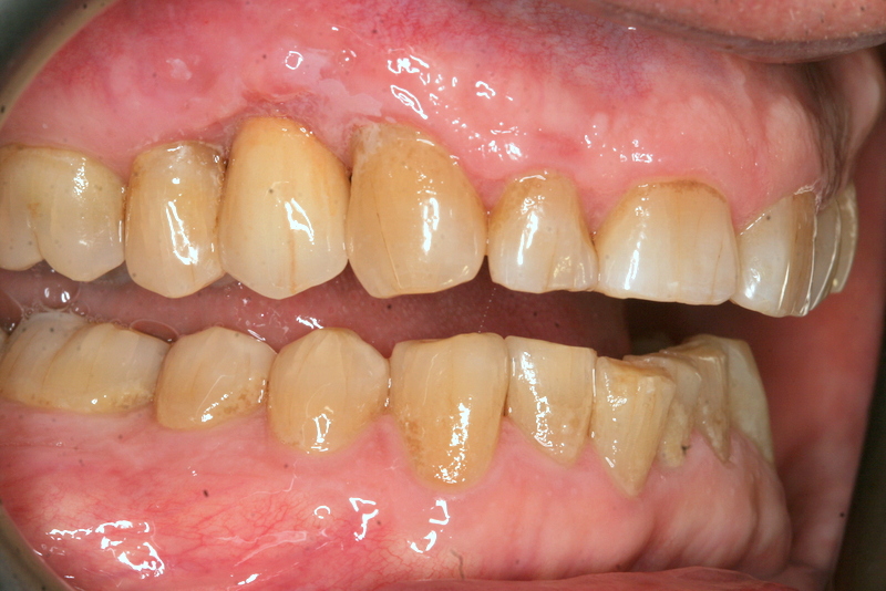 upper premolar after