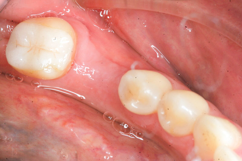Zirconia implants - healed after extraction from top