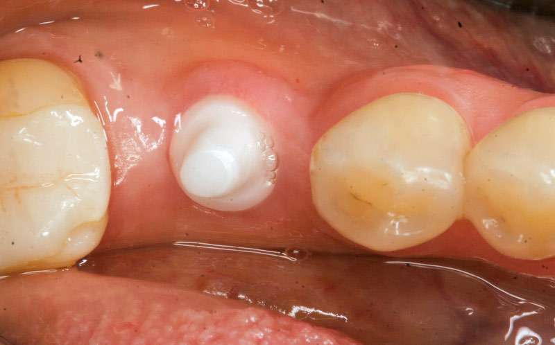 Zirconia implants - healed implant after 4 month