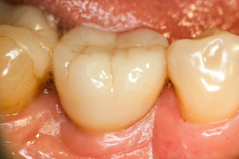 Zirconia implants - restored with crown sidse view